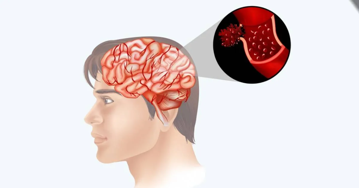 Blood Clots in the Brain: A Guide to this Neurological Disorder