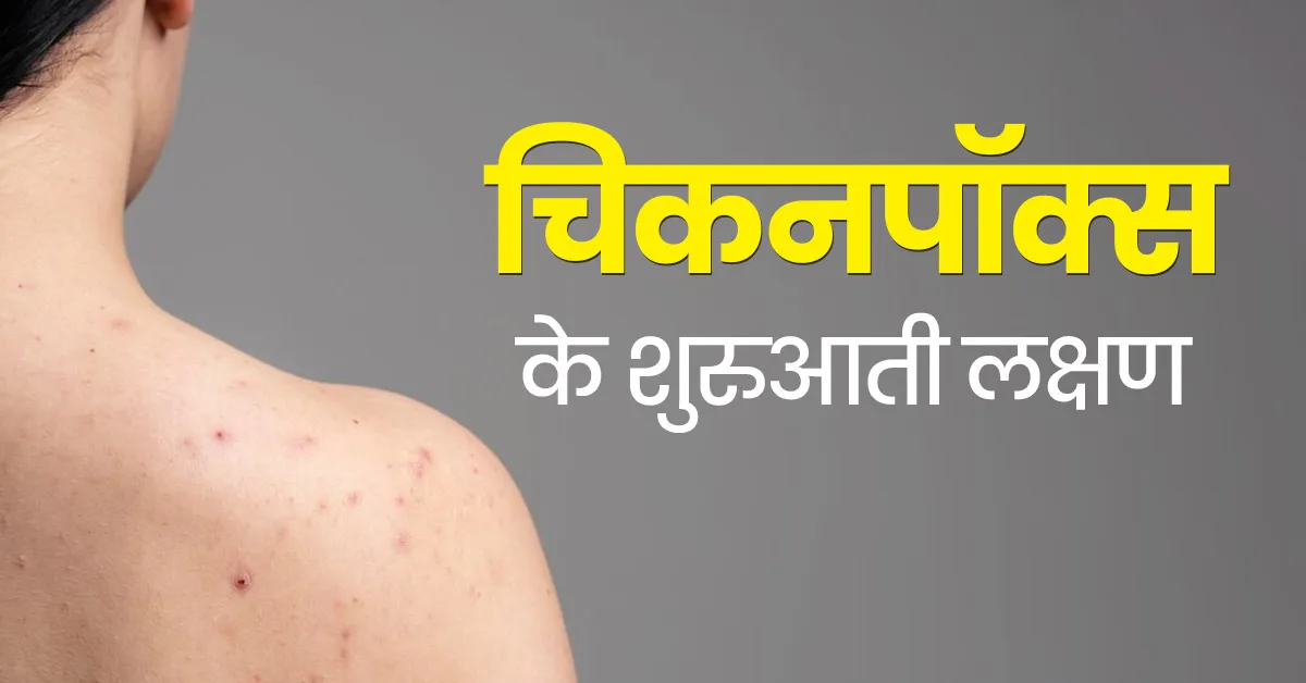चिकनपॉक्स (बड़ी माता): लक्षण और इलाज | नोवा हॉस्पिटल