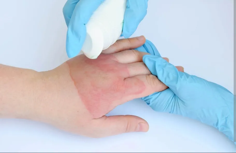 Burn Treatment in Meerut: Expert Care for Burn Injuries at Nova Hospital