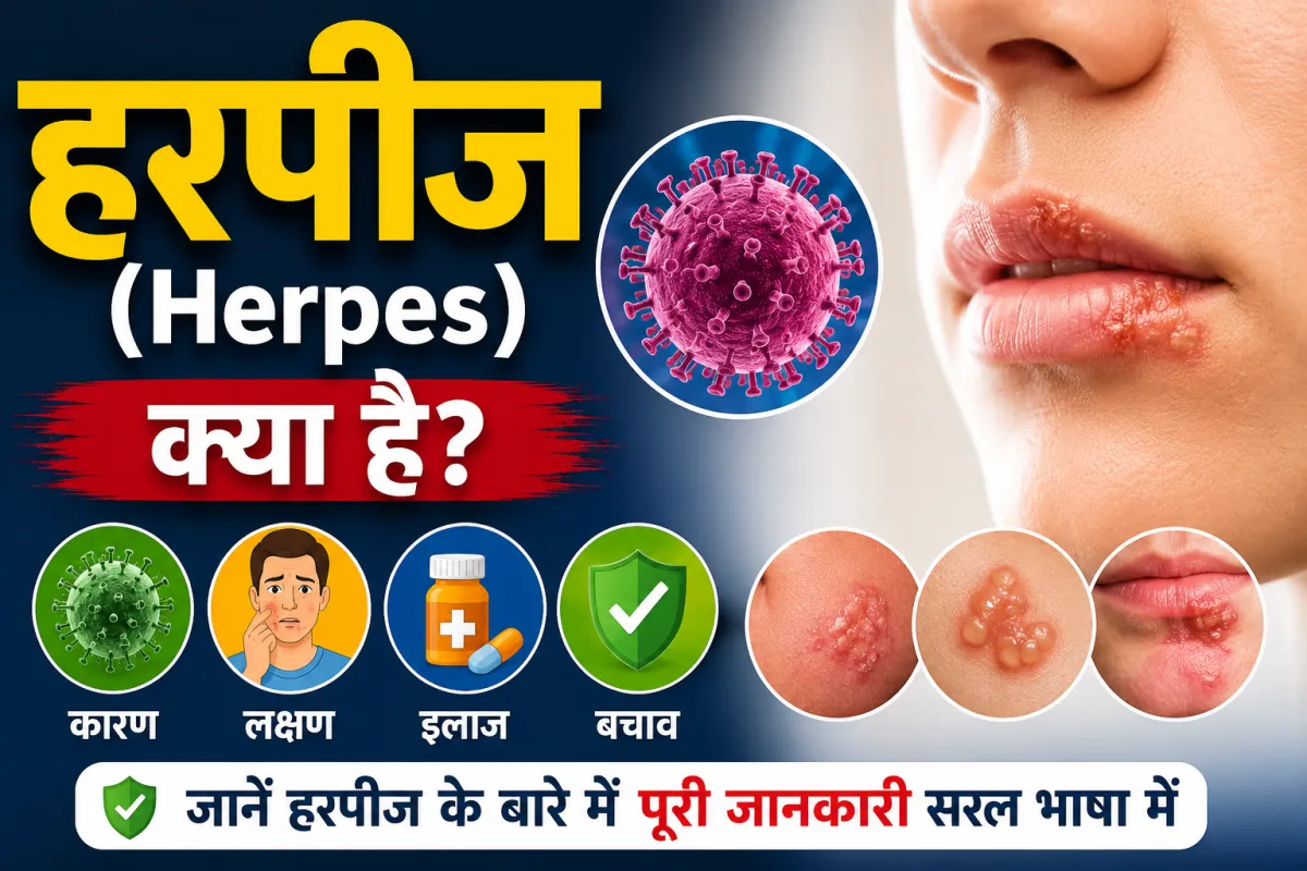 हर्पीस (Herpes) क्या है? लक्षण, इलाज और यह कितने दिन में ठीक होता है?